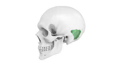(IMAGE 2) LEFORTE NEURO SYSTEM